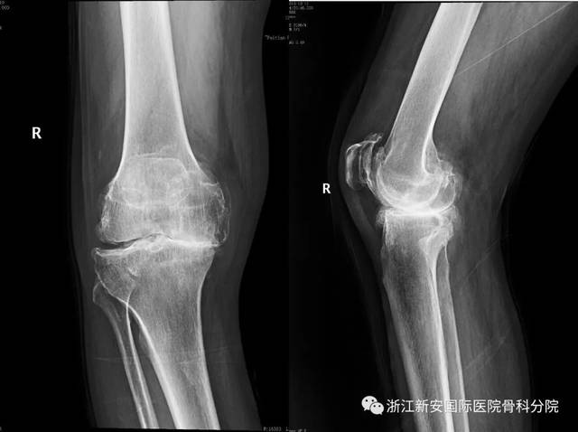 膝骨关节炎专题(二)——严重畸形的膝关节也能让你恢复正常