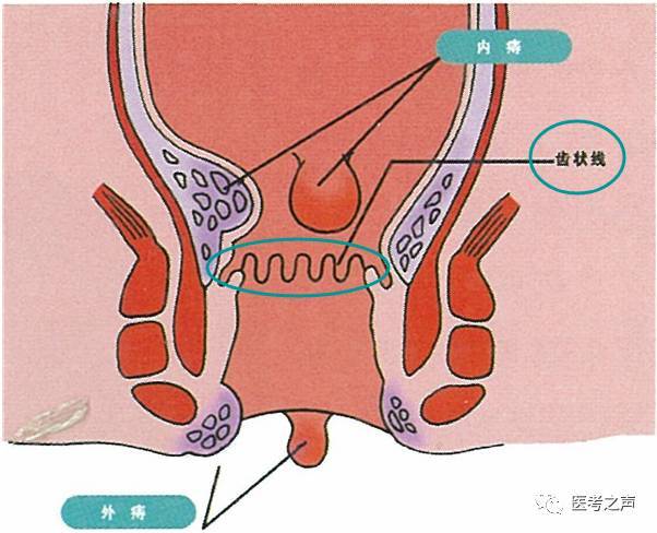 看图秒懂:内痔,外痔,混合痔,怎么区分?