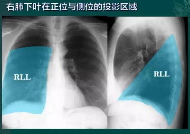 送你7个窍门,手把手教你解读胸片