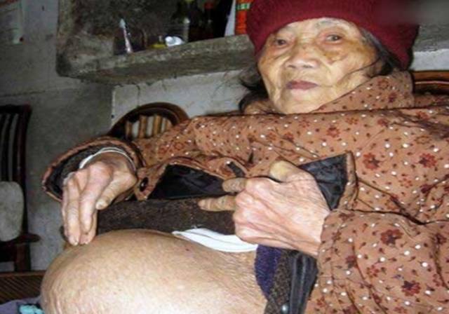 91岁老人 腹 中发现 61岁 胎儿,超强钉子户婴儿令人震惊 !