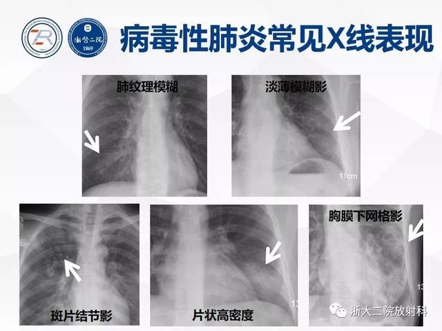 病毒性肺炎长啥样?胸片细节见真章