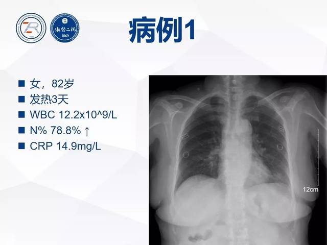 病毒性肺炎长啥样?胸片细节见真章
