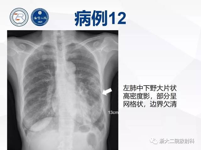 病毒性肺炎长啥样?胸片细节见真章