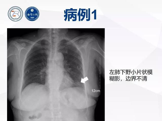 非常重要 | 病毒性肺炎普通x线诊断