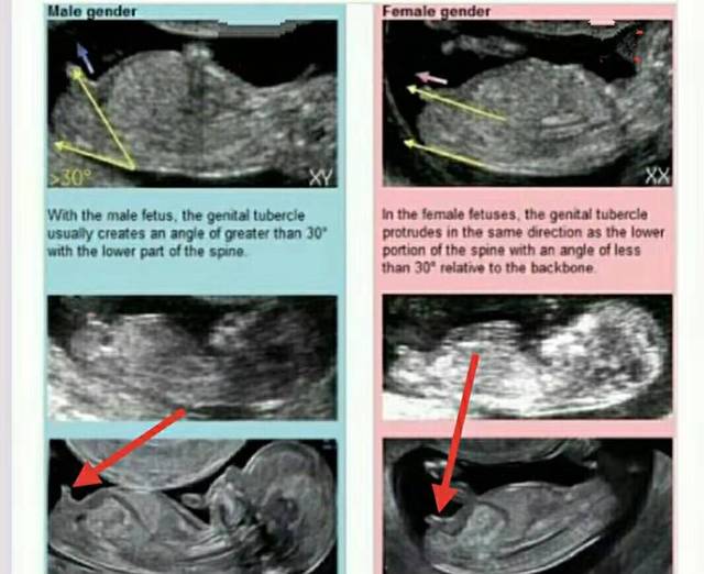 怀孕3个月胎儿变化大:nt图能看胎儿性别?别说,还真有些门道