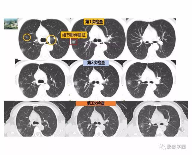 郭佑民教授:输入性新冠肺炎的影像学特点与识别