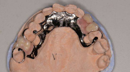 可摘局部义齿和  全口义齿;下面要说的是可摘局部义齿,俗称"活动义齿"