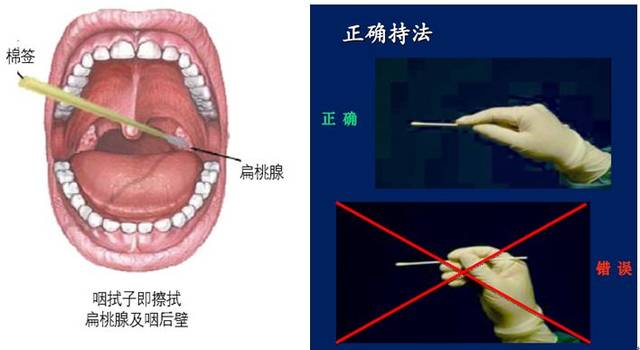 两根聚丙烯纤维头的塑料杆拭子同时檫拭双侧咽扁桃体及咽后壁