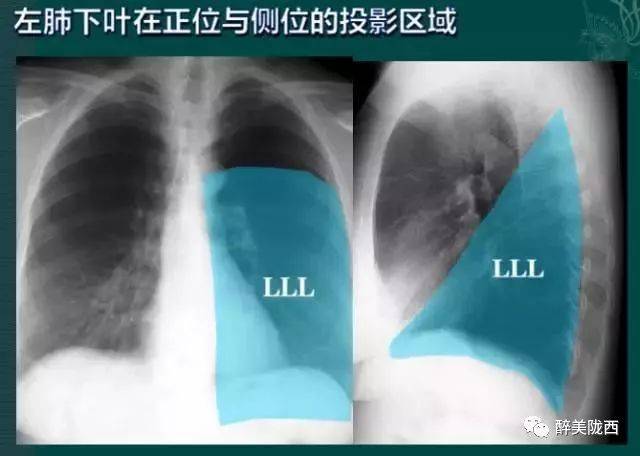 拿到胸片却不会看?送你7个窍门,手把手教你解读胸片(收藏)