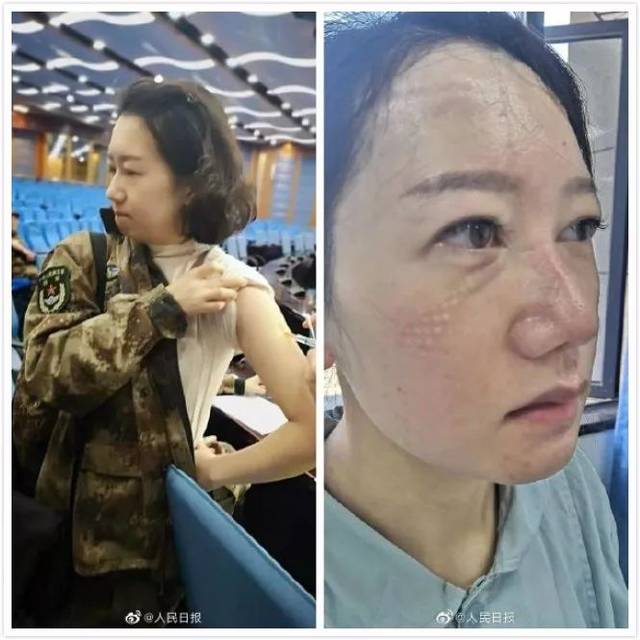 几天后再看见她,口罩和护目镜在她脸上留下了深深的勒痕,这是陆军军医