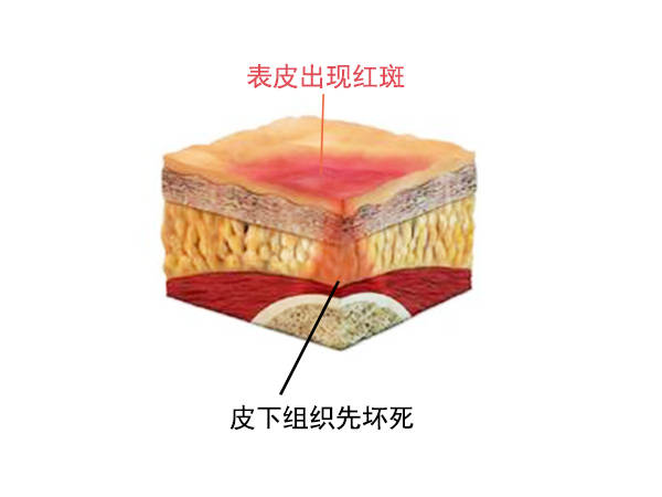 褥疮最早初期图片是什么?初期褥疮如何快速好?