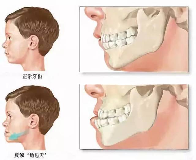 3,口呼吸:导致上颌前突,牙弓狭窄等面型.
