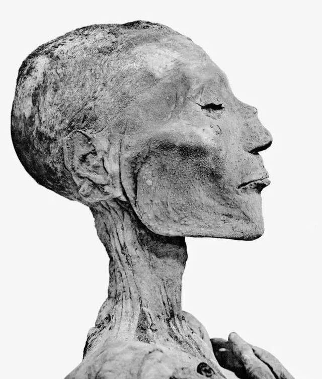 拉美西斯五世的木乃伊头像,可见天花感染过的痕迹 拉美西斯五世的