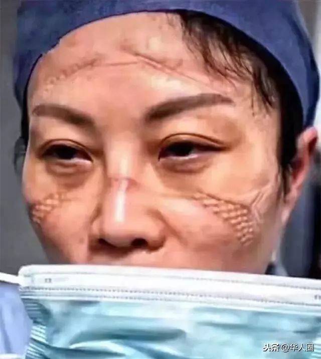 看了中国医生满脸勒痕照片,国外网友的评论好暖