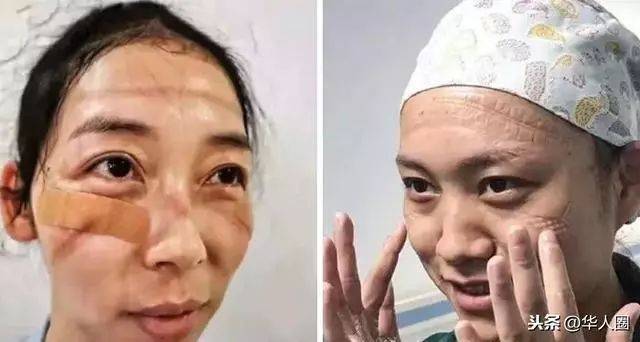 看了中国医生满脸勒痕照片,国外网友的评论好暖