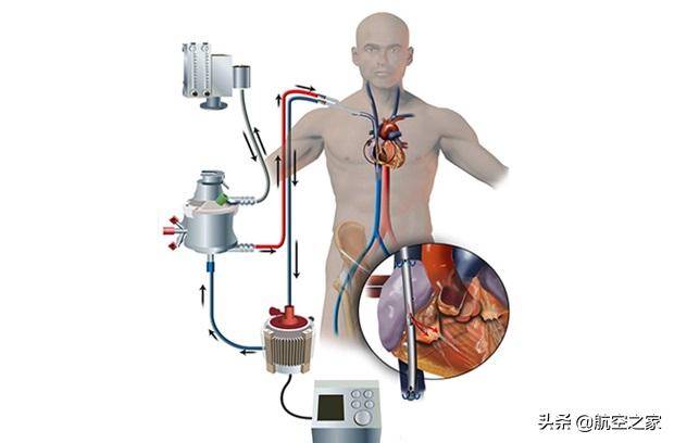 原创icu的"终极武器":ecmo人工肺,全国才有400多台,单价达百万