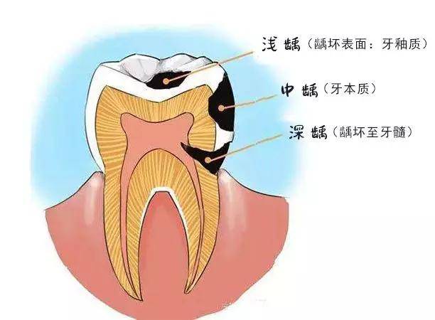 孩子"十牙九蛀"家长这种观念是"隐形杀手(附蛀牙自测图)