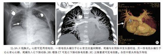 44 岁女性患者(病例3)x线胸片和肺动脉ct图像