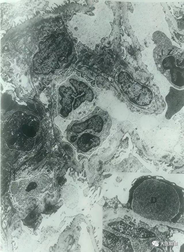 一例肾穿活检,透射电镜观察,拍照,图中可见肾小球脏层上皮细胞下驼峰