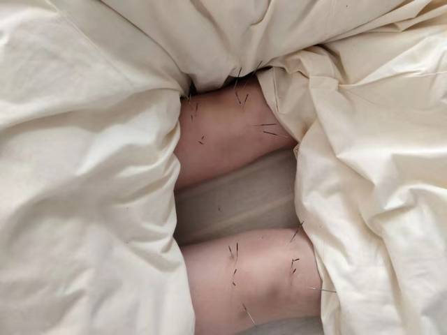 杨琴抽时间在医院针灸理疗自己的双腿