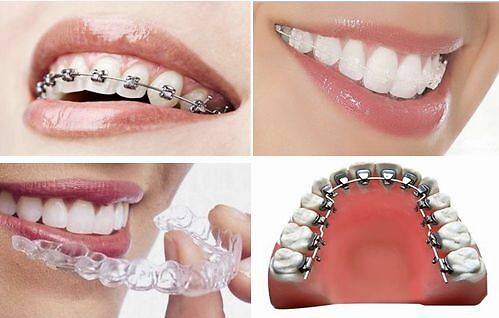 骨性龅牙戴牙套有用吗?