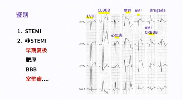 图源:心电图识图诊断训练营课件 除了早期复极,clbbb,心包炎,高钾血