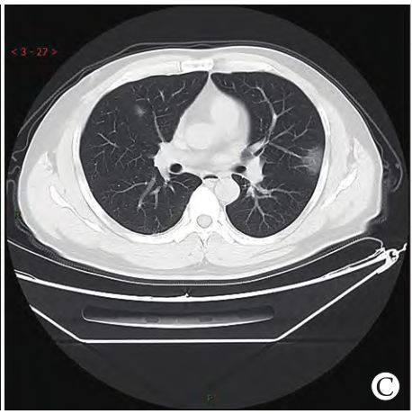 新冠肺炎(covid-19)影像ct,dr,us合集