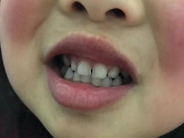 宝宝牙齿上出现了白垩色到黄色的缺损,再到棕色,黑色的蛀洞,这是蛀牙