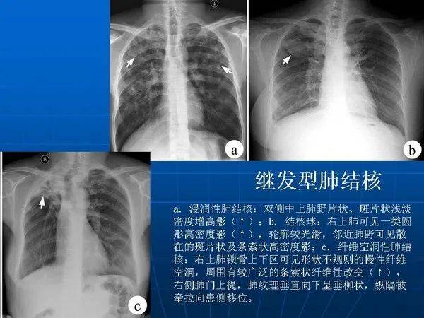 各型肺结核的典型影像表现