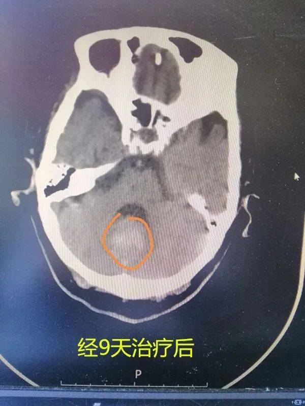 抗"疫,诊疗两不误—我院神经内科成功救治一位高龄小脑蚓部出血