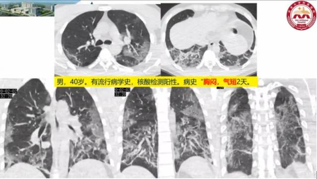 "白肺";48 h病灶范围增加50%;此外,可见有肺纤维化