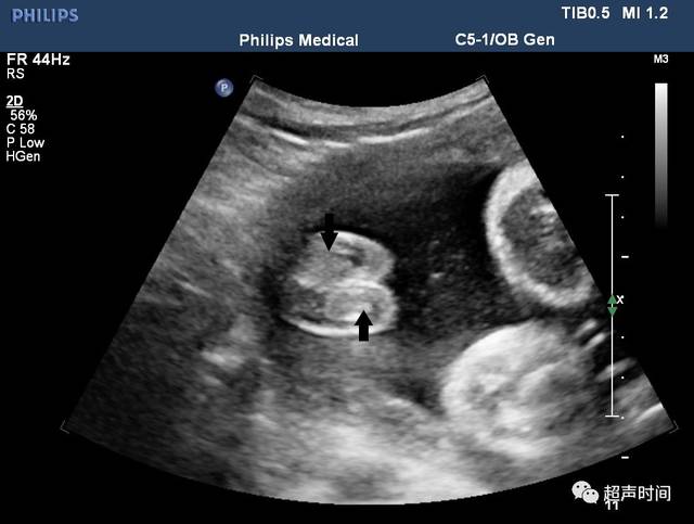 二维超声:胎儿双侧阴囊内可见睾丸回声(图 1).