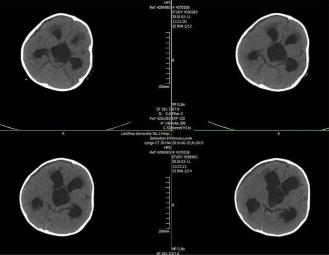 头颅核磁提示:重度脑积水;第三脑室和两侧侧脑室额角明显扩张,轴位上