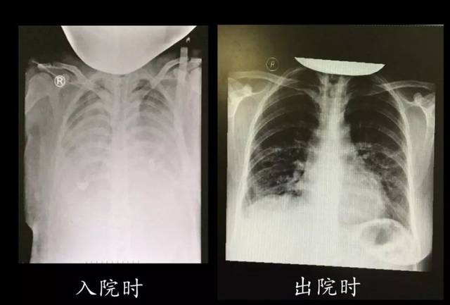我们来看下面这张图,左边这张就是大白肺的胸片,右边这张是经过治疗