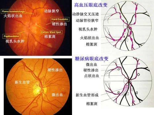 有高血压的你当心眼底病变_手机搜狐网