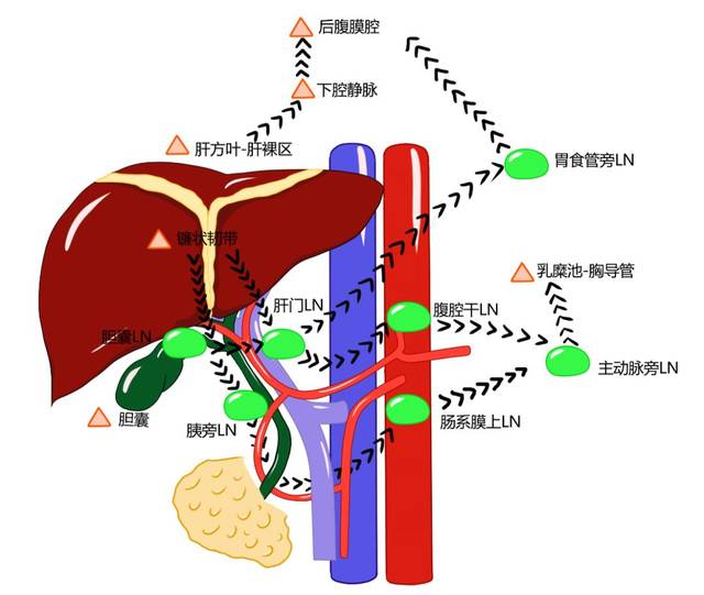 3 张手绘图,教你读懂肝脏淋巴回流