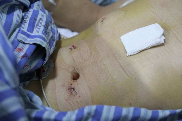 贺州广济医院成功开展3d全腔镜下食管癌根治术,食管癌