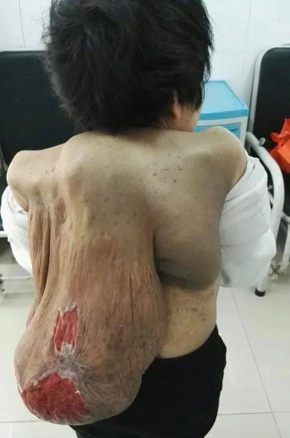 27 岁 简要病史:躯干,四肢多个软组织肿块,以背部为甚,合并脊柱畸形