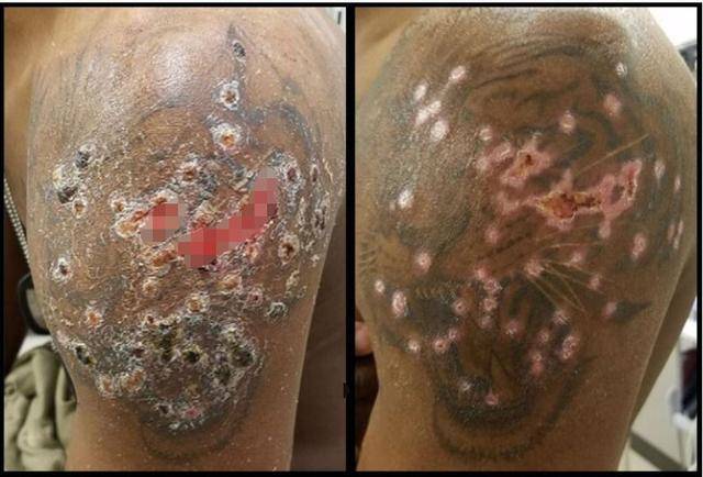 美军士兵接种疫苗后纹身,抓挠引发的皮肤感染溃烂