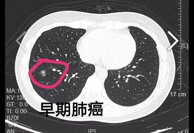 有些人甚至是刚刚在其他医院做了胸片,但都没有发现肺癌