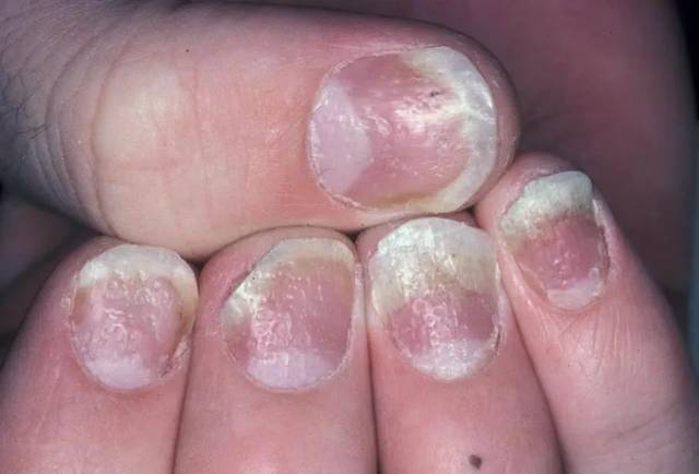 10种可能误诊为甲真菌病的指甲病变