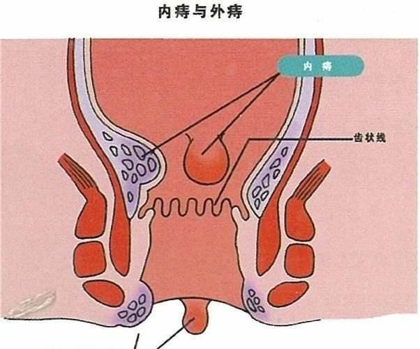 痔疮到底是怎么引起的