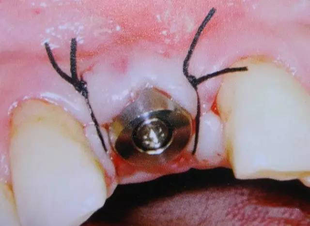 待种植钉与牙槽骨紧密愈合后,安装牙冠后就完成了整个种植牙手术的全