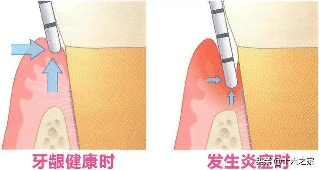 牙周探诊srp解析1