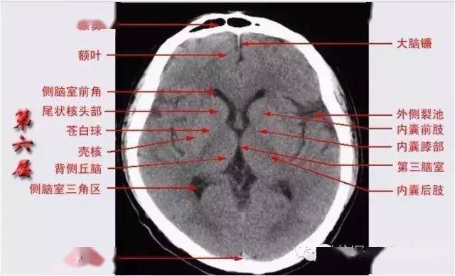 颅脑ct解剖口诀及彩色解剖图