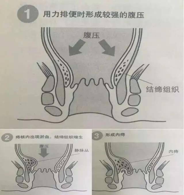 得了产后痔疮,整个人都不好了.