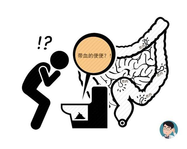 肠内有癌,大便先知?若排便出现4种现象,暗示直肠癌已到来?