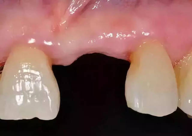 牙齿粘结修复容易出现哪些问题?