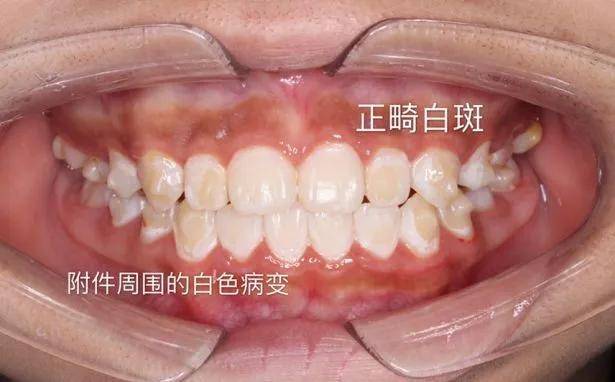 【科普】正畸时牙齿出现白斑是怎么回事?