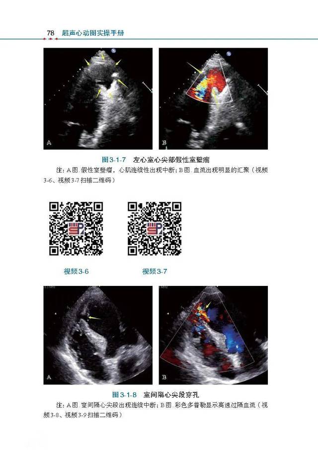 《超声心动图实操手册》:99个超声心动图影像视频,带你看图识病